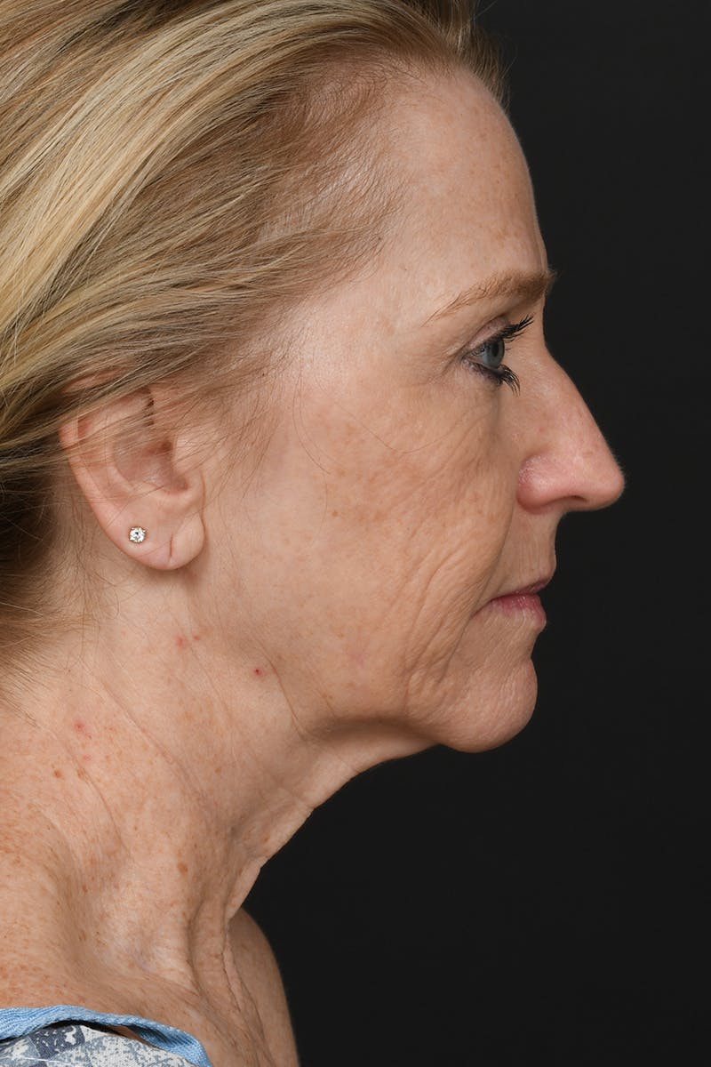 Facelift Before & After Gallery - Patient 323987 - Image 5