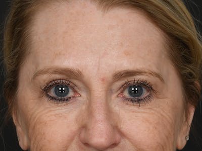 Blepharoplasty Before & After Gallery - Patient 966371 - Image 1