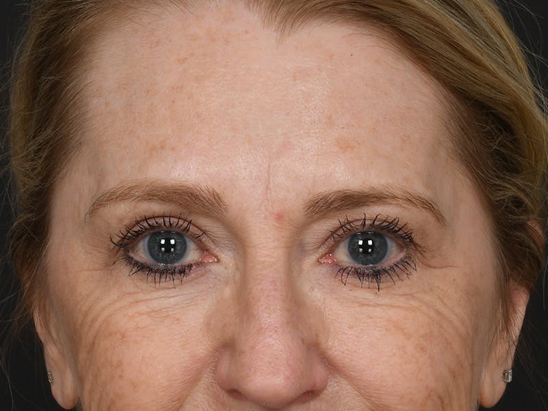Blepharoplasty Before & After Gallery - Patient 966371 - Image 1