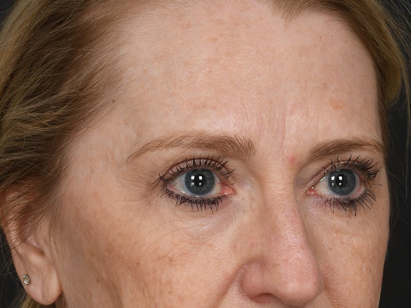 Blepharoplasty Before & After Gallery - Patient 966371 - Image 3