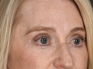 Blepharoplasty Before & After Gallery - Patient 966371 - Image 4