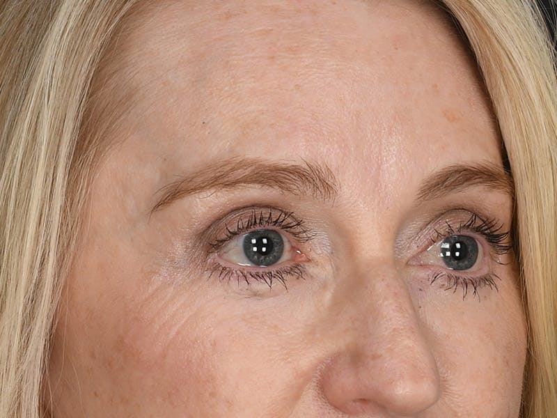 Blepharoplasty Before & After Gallery - Patient 966371 - Image 4