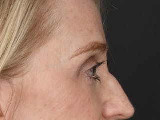 Blepharoplasty Before & After Gallery - Patient 966371 - Image 6