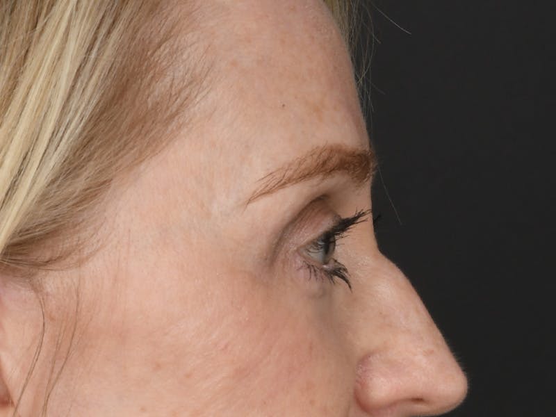 Blepharoplasty Before & After Gallery - Patient 966371 - Image 6