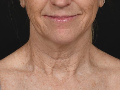 Neck Lift Before & After Gallery - Patient 292300 - Image 1
