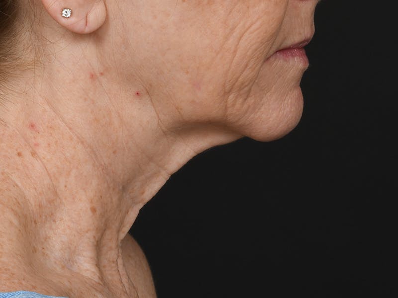 Neck Lift Before & After Gallery - Patient 292300 - Image 5