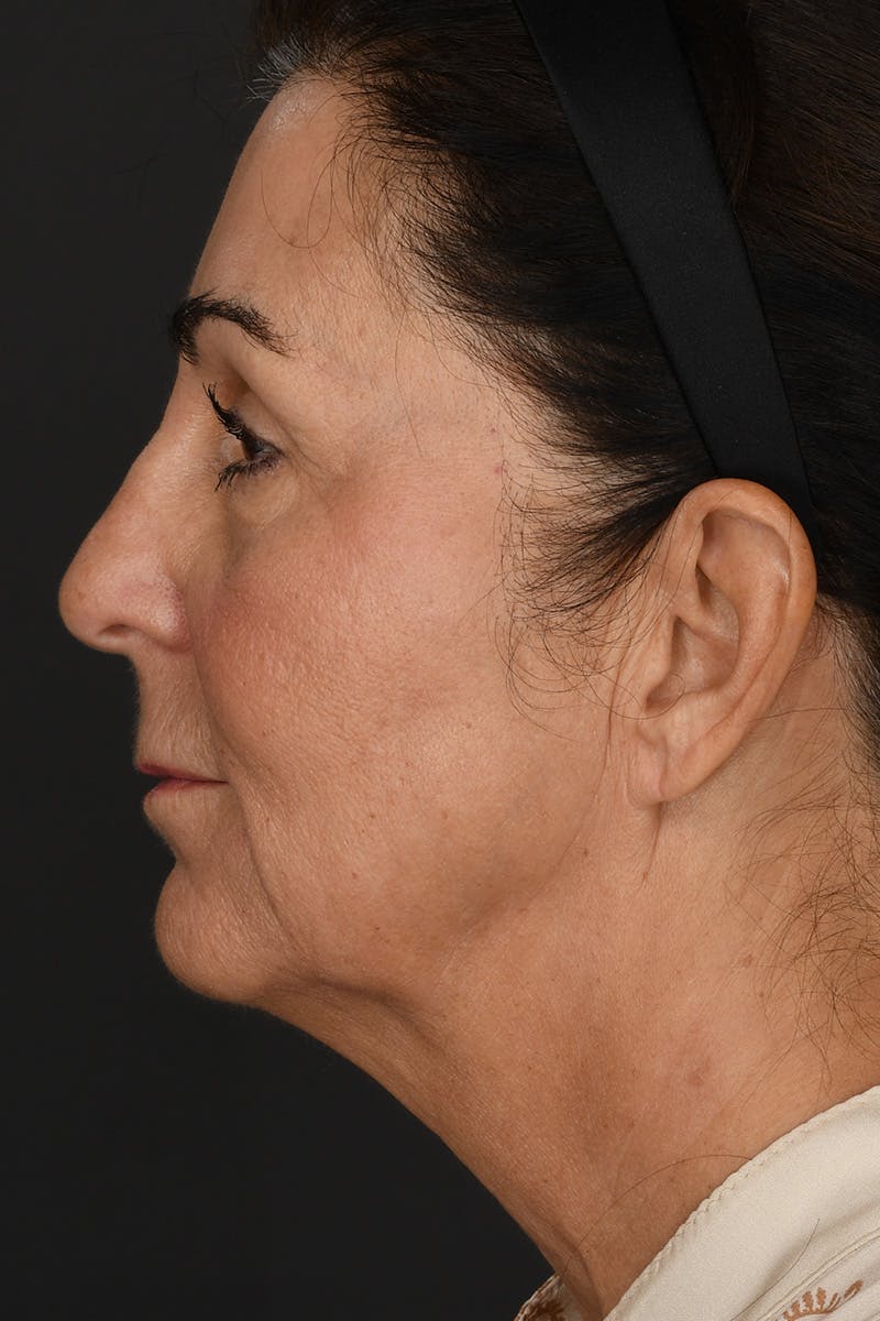 Facelift Before & After Gallery - Patient 213529 - Image 5