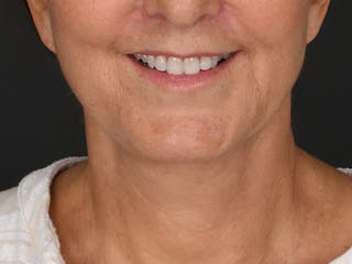 Neck Lift Before & After Gallery - Patient 330055 - Image 2