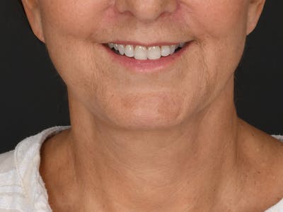 Neck Lift Before & After Gallery - Patient 330055 - Image 2