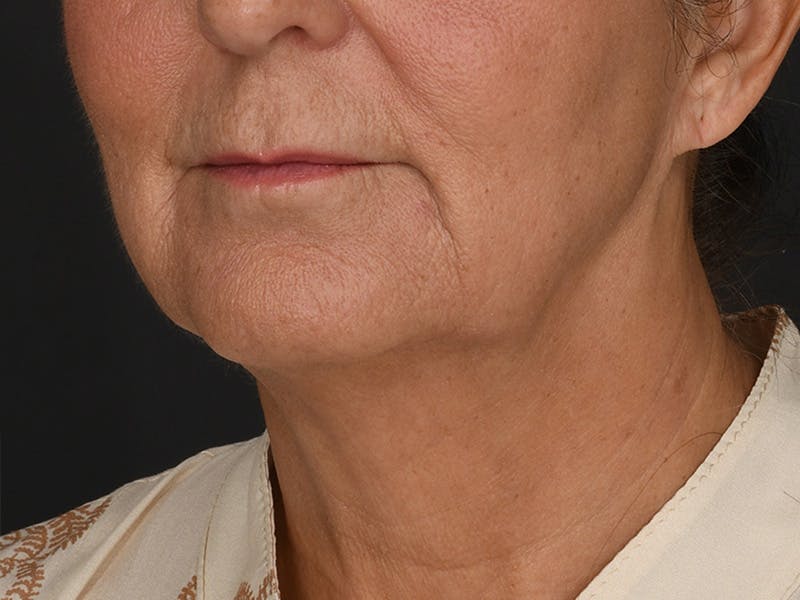 Neck Lift Before & After Gallery - Patient 330055 - Image 3