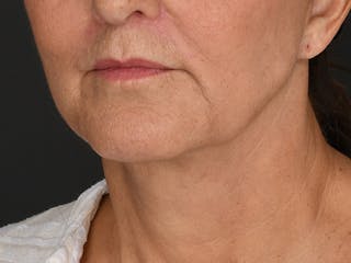 Neck Lift Before & After Gallery - Patient 330055 - Image 4