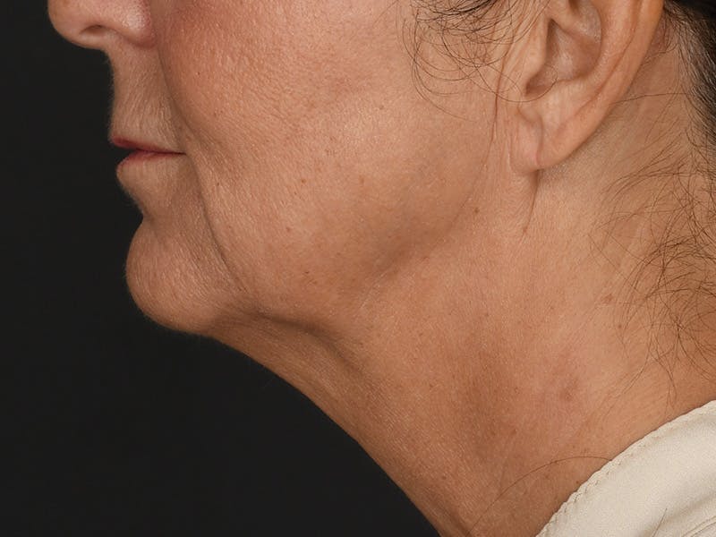 Neck Lift Before & After Gallery - Patient 330055 - Image 5