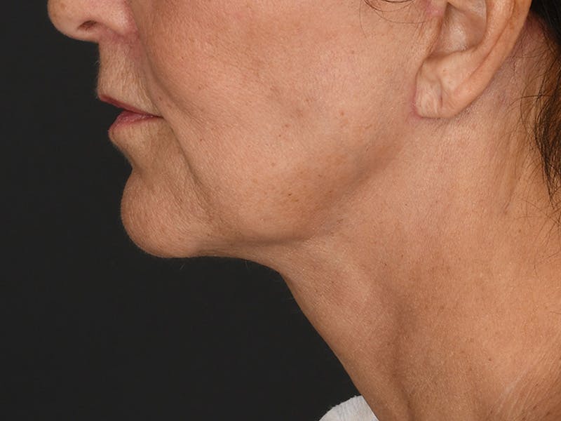 Neck Lift Before & After Gallery - Patient 330055 - Image 6