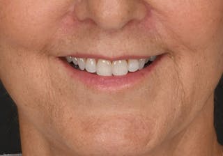 Lip Lift Before & After Gallery - Patient 166762 - Image 2