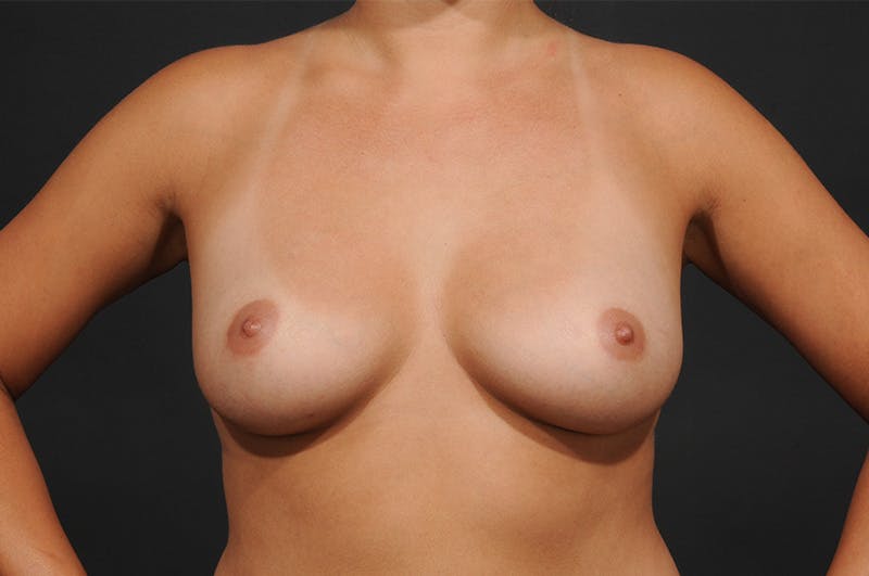 Breast Augmentation Before & After Gallery - Patient 940570 - Image 1