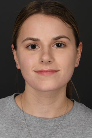 Rhinoplasty Before & After Gallery - Patient 346070 - Image 4