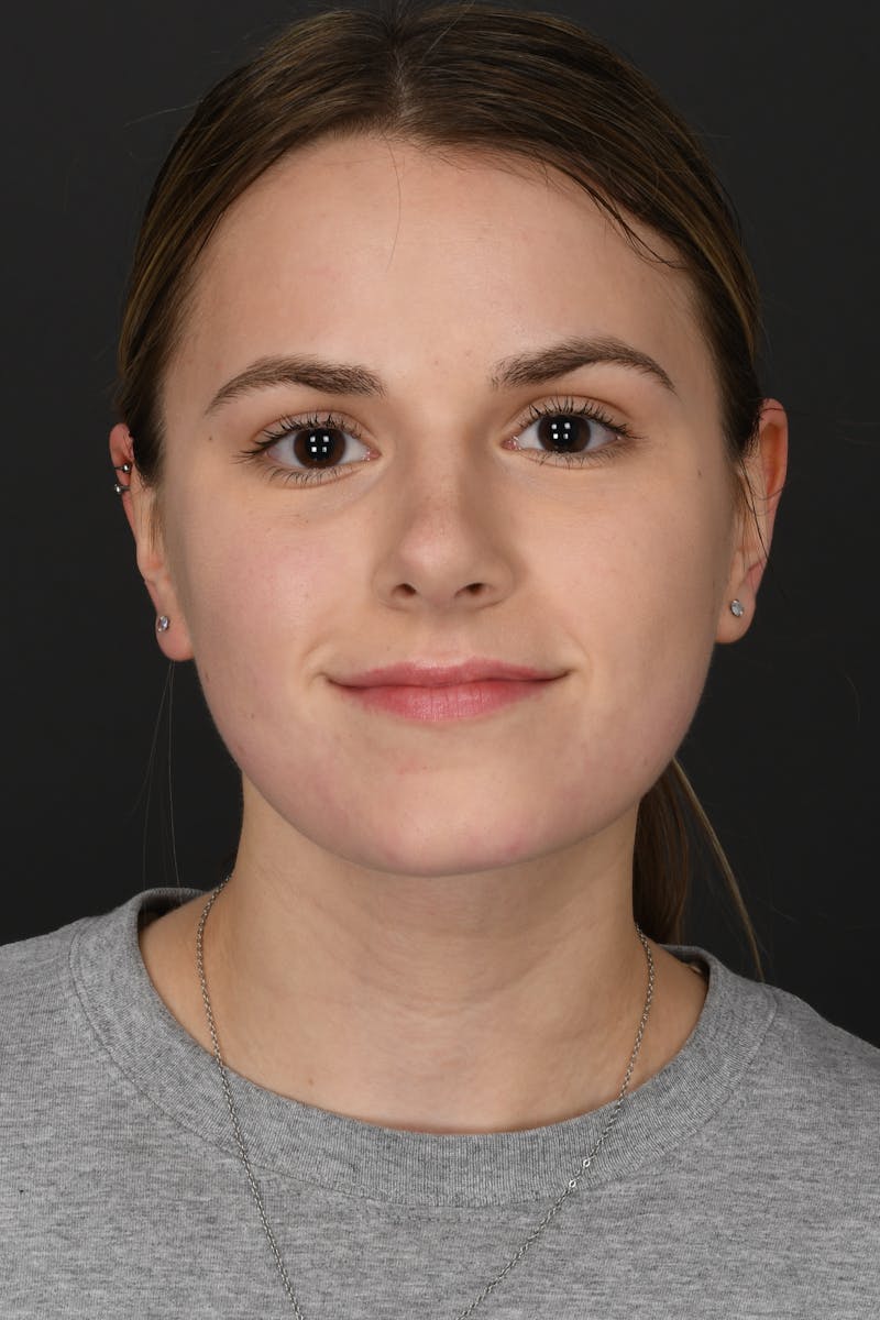 Rhinoplasty Before & After Gallery - Patient 346070 - Image 4