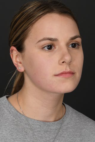 Rhinoplasty Before & After Gallery - Patient 346070 - Image 6
