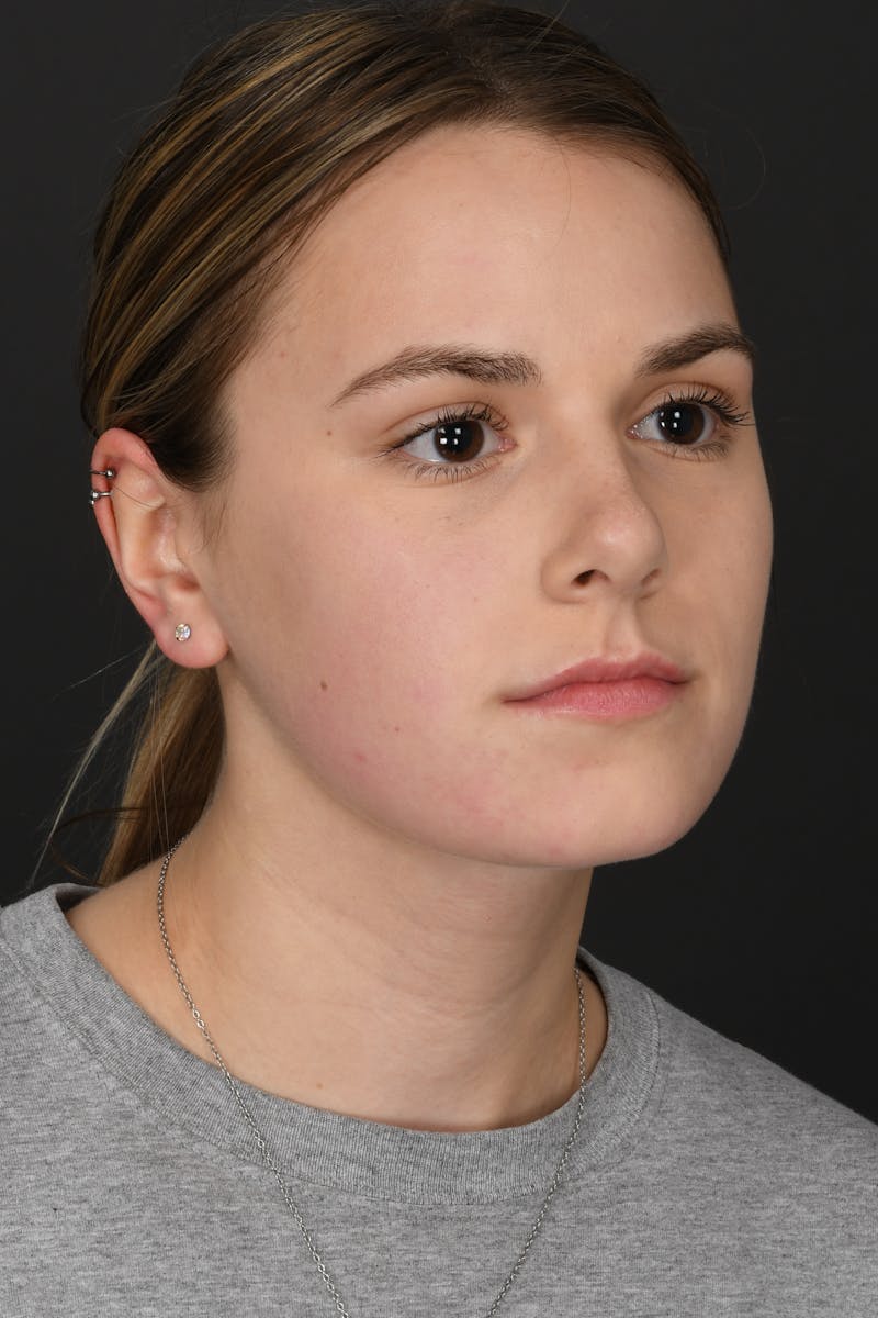 Rhinoplasty Before & After Gallery - Patient 346070 - Image 6