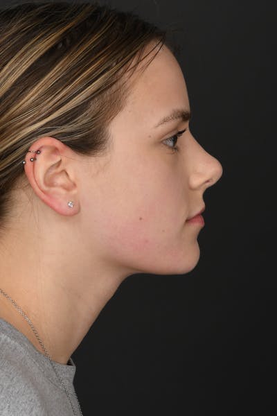 Rhinoplasty Before & After Gallery - Patient 346070 - Image 2
