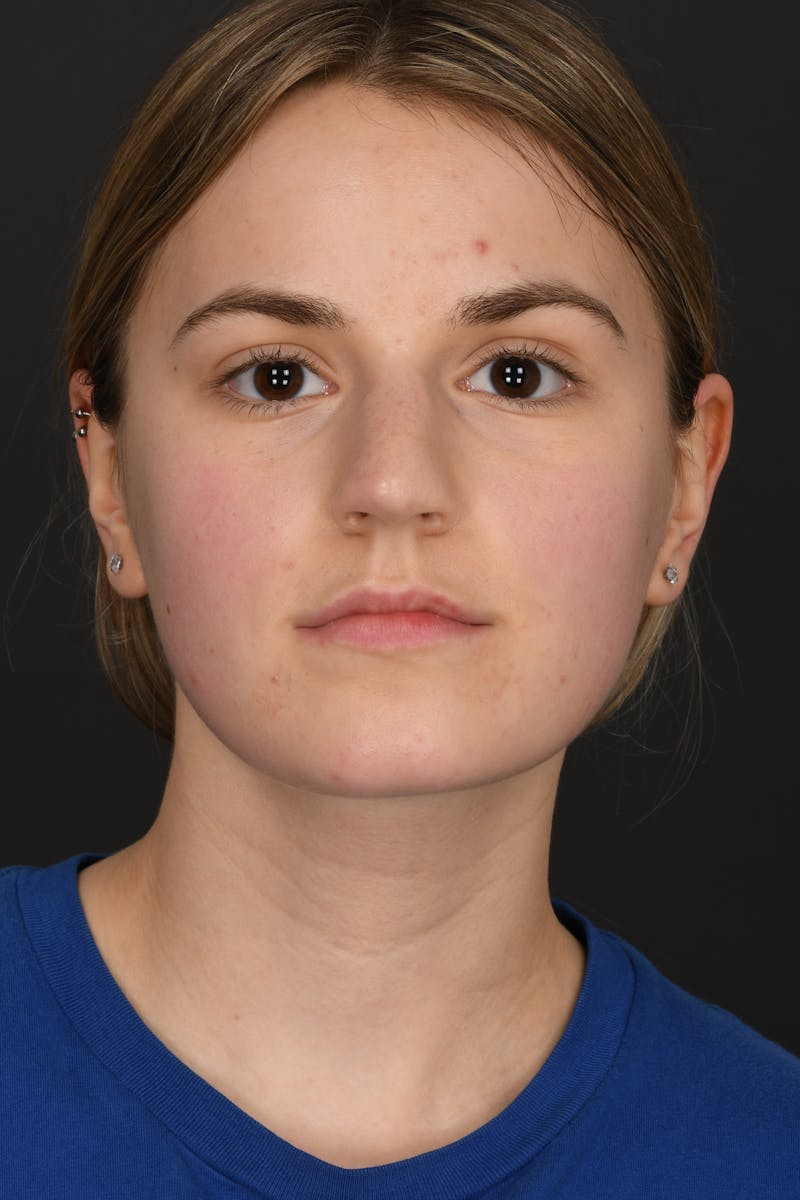 Rhinoplasty Before & After Gallery - Patient 346070 - Image 3