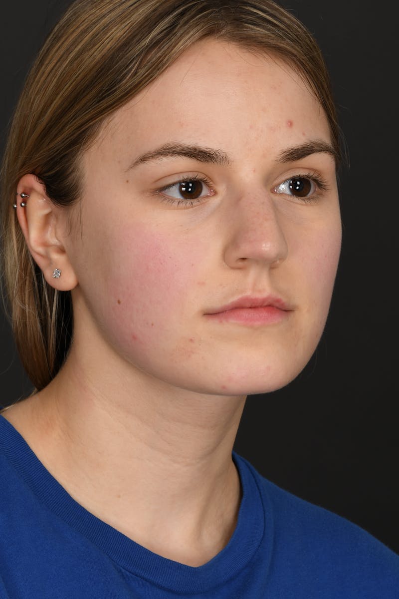 Rhinoplasty Before & After Gallery - Patient 346070 - Image 5