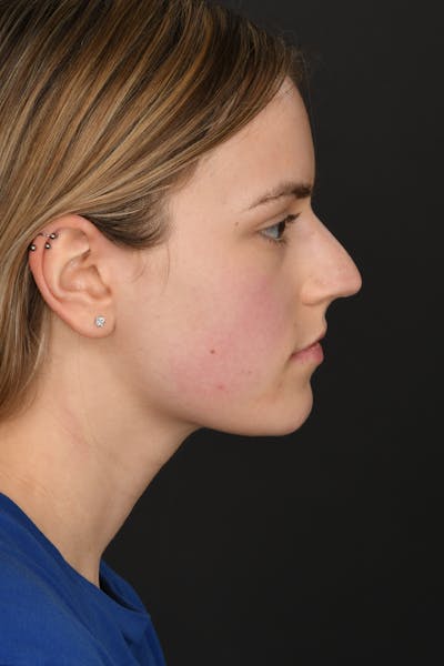 Rhinoplasty Before & After Gallery - Patient 346070 - Image 1
