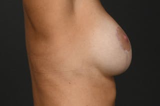 Breast Lift Before & After Gallery - Patient 151063 - Image 6