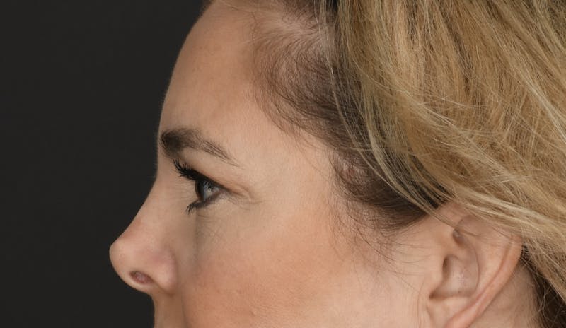 Blepharoplasty Before & After Gallery - Patient 160608 - Image 5