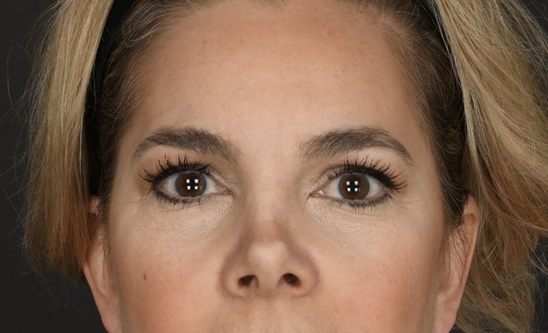 Blepharoplasty Before & After Gallery - Patient 160608 - Image 1