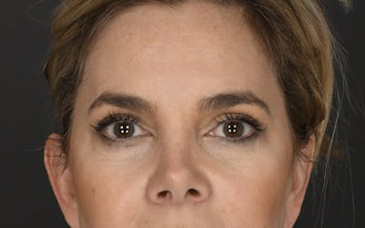 Blepharoplasty Before & After Gallery - Patient 160608 - Image 2