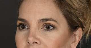 Blepharoplasty Before & After Gallery - Patient 160608 - Image 4