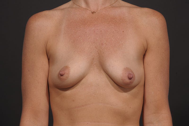 Breast Augmentation Before & After Gallery - Patient 338284 - Image 1