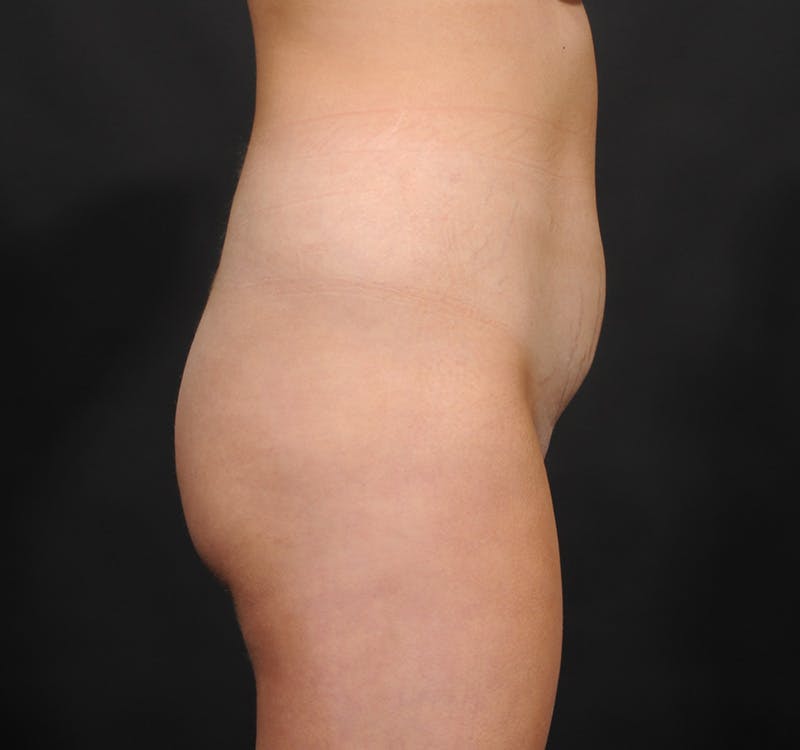Liposuction Before & After Gallery - Patient 750803 - Image 3