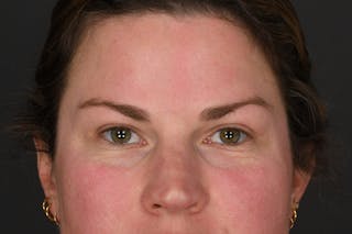 Blepharoplasty Before & After Gallery - Patient 243179 - Image 2