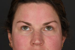 Blepharoplasty Before & After Gallery - Patient 243179 - Image 4