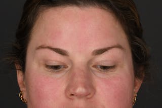 Blepharoplasty Before & After Gallery - Patient 243179 - Image 6