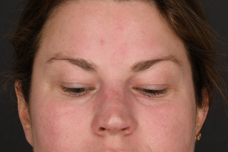 Blepharoplasty Before & After Gallery - Patient 243179 - Image 5