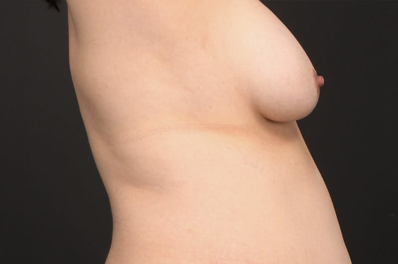 Breast Lift Before & After Gallery - Patient 287258 - Image 3