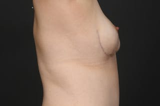 Breast Lift Before & After Gallery - Patient 287258 - Image 4