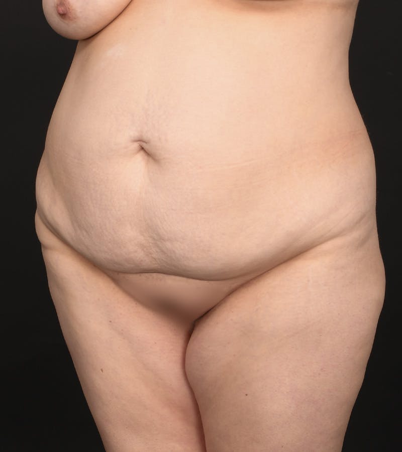 Tummy Tuck Before & After Gallery - Patient 126406 - Image 1