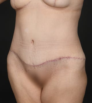 Tummy Tuck Before & After Gallery - Patient 126406 - Image 2