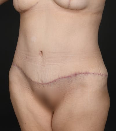 Tummy Tuck Before & After Gallery - Patient 126406 - Image 2