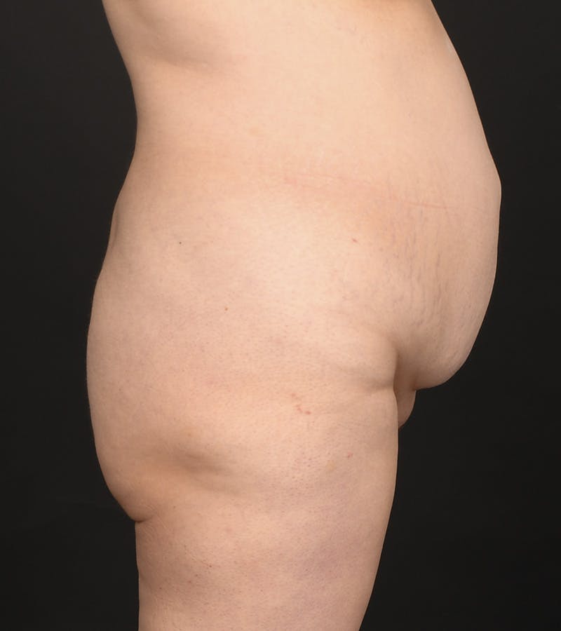 Tummy Tuck Before & After Gallery - Patient 126406 - Image 3