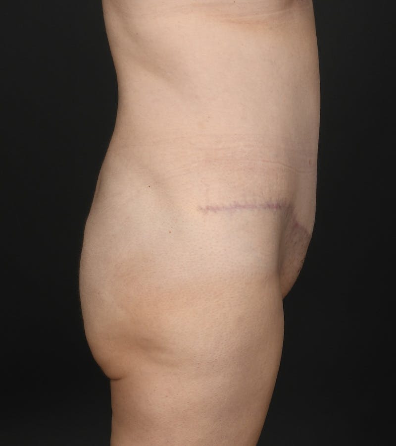 Tummy Tuck Before & After Gallery - Patient 126406 - Image 4