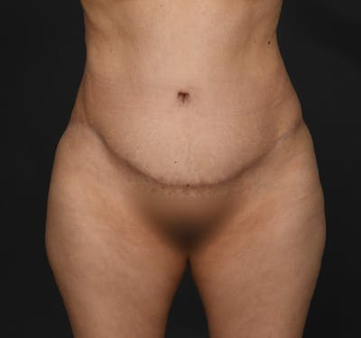 Tummy Tuck Before & After Gallery - Patient 290671 - Image 2