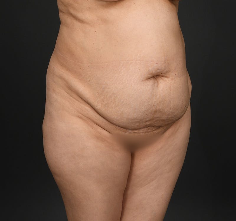 Tummy Tuck Before & After Gallery - Patient 290671 - Image 3