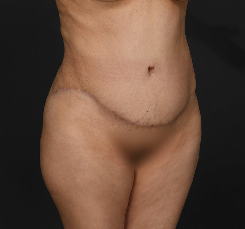 Tummy Tuck Before & After Gallery - Patient 290671 - Image 4