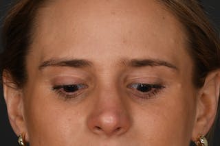 Blepharoplasty Before & After Gallery - Patient 133954 - Image 4