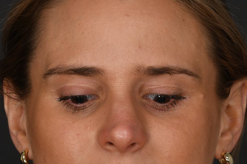 Blepharoplasty Before & After Gallery - Patient 133954 - Image 4